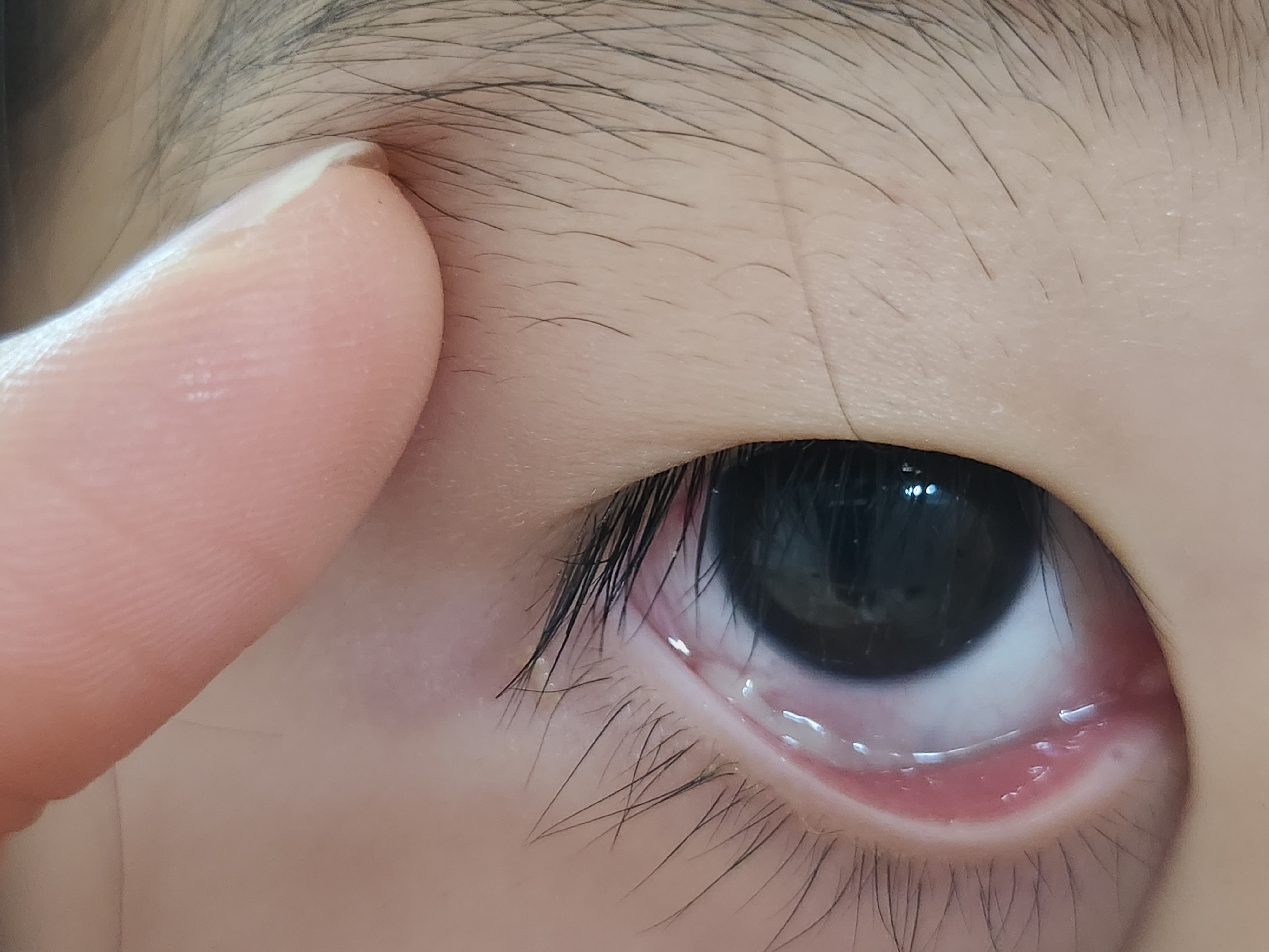 눈곱감기 아데노바이러스의 모든 것feat 파라바이러스