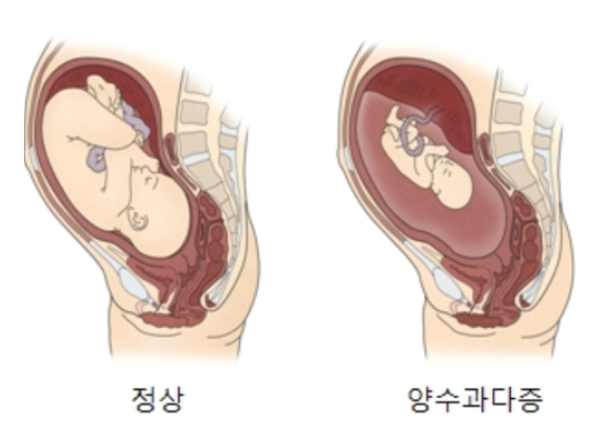 아기의 보금자리 양수에 대한 모든 것
