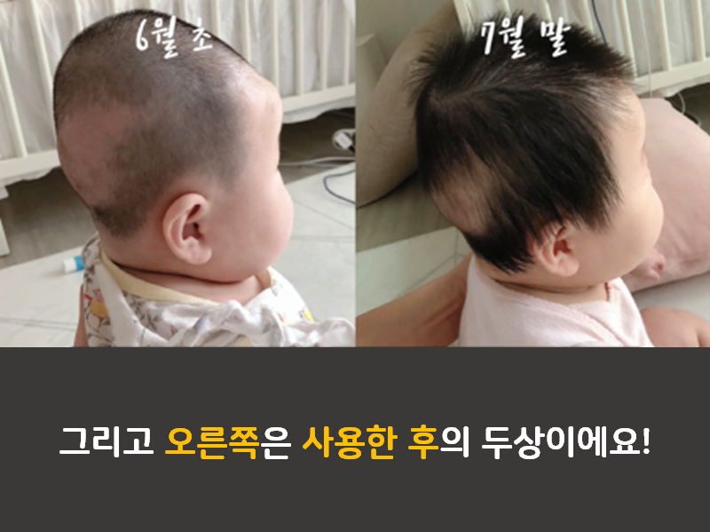 바디필로우 사용 전후 두상변화 인증