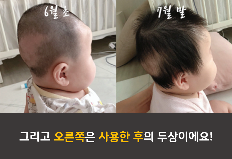 바디필로우 사용 전후 두상변화 인증
